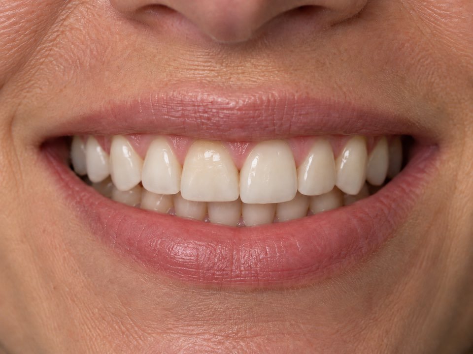 Apr&egrave;s le traitement : sourire harmonieusement am&eacute;lior&eacute; avec un r&eacute;sultat naturel