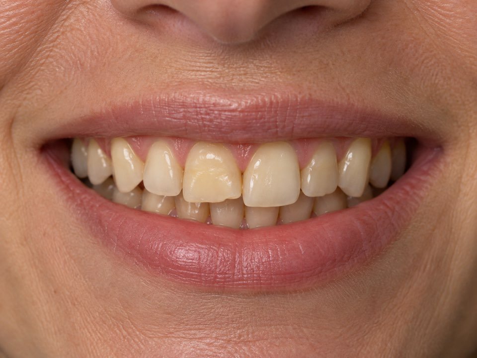 Avant le traitement : sourire naturel pr&eacute;sentant des imperfections esth&eacute;tiques