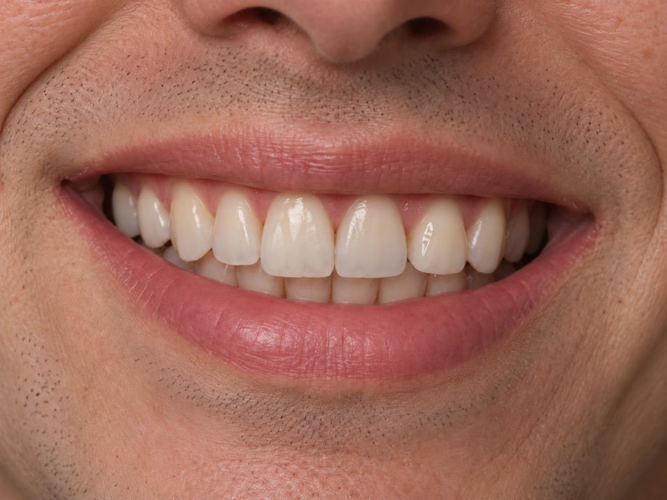 Après le traitement : sourire avec la dent antérieure restaurée